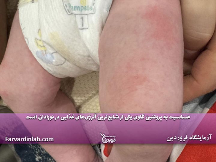 حساسیت به پروتئین گاوی در نوزاد