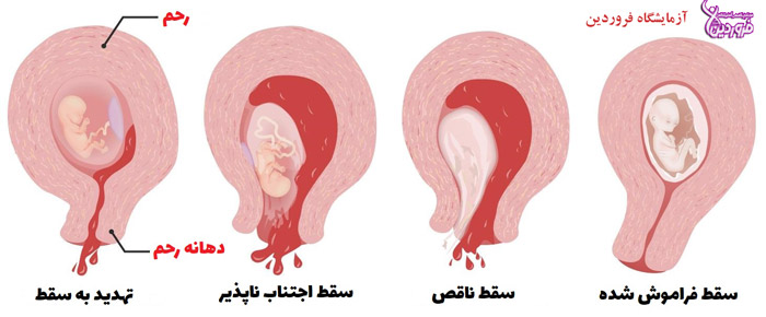 انواع سقط جنین چیست