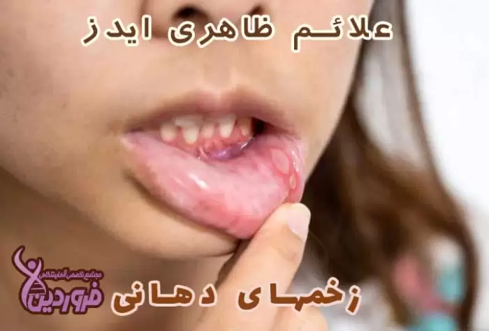 علائم حتمی ایدز چیست