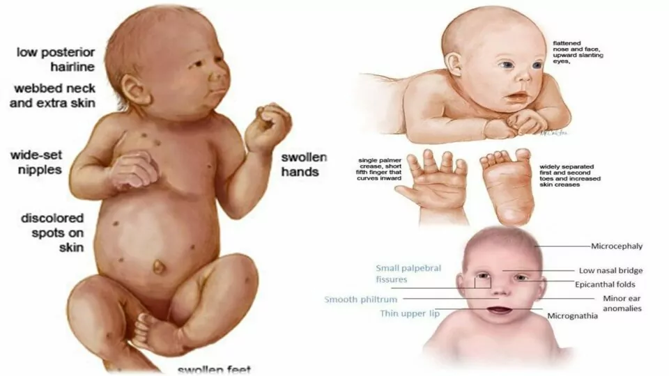 آزمایش کاریوتایپ - سندرم ترنر