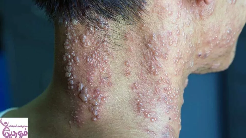 زونا - آزمایشگاه فروردین