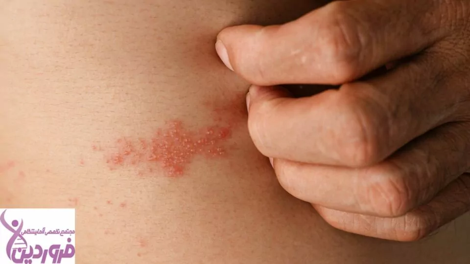 زونا - آزمایشگاه فروردین