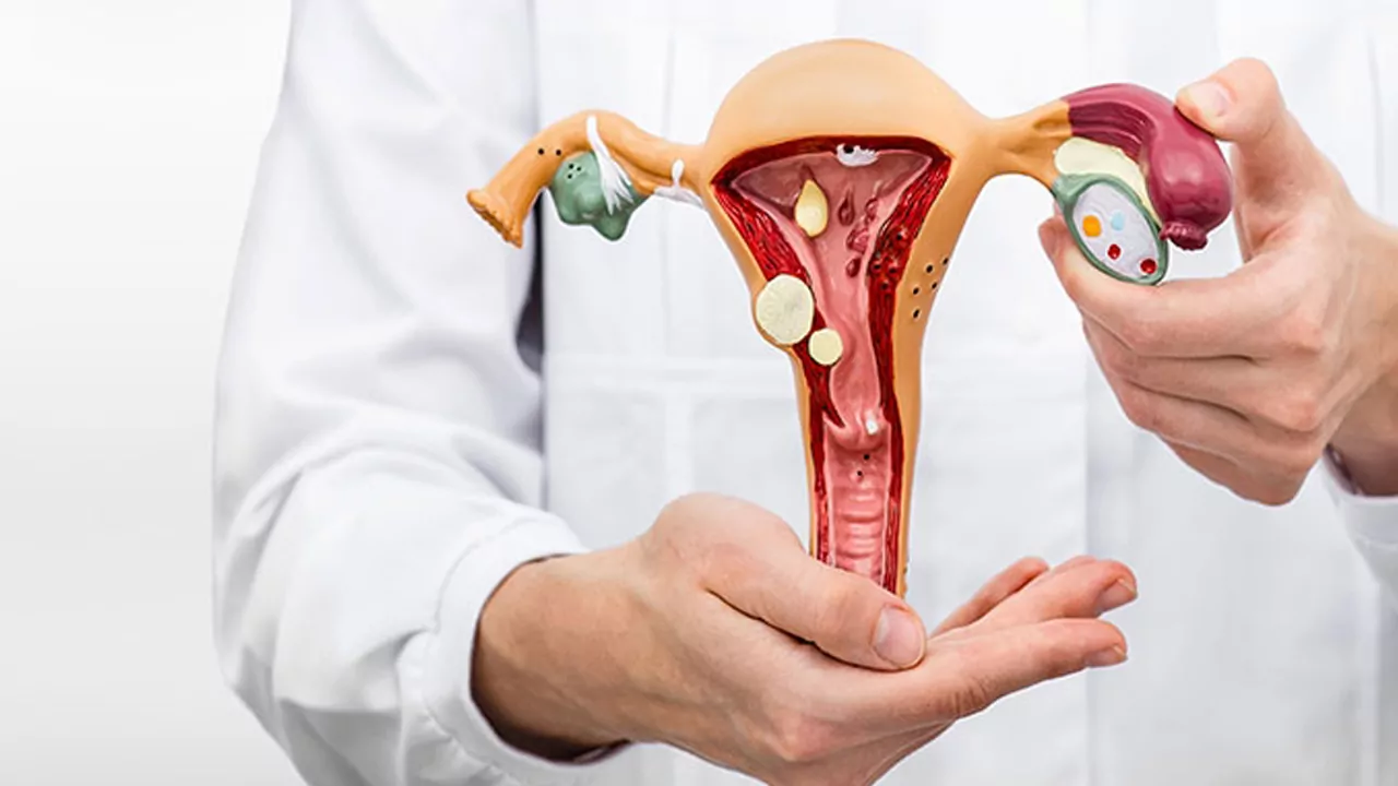 سرطان تخمدان