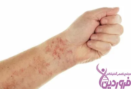 علائم سرطان خون - کبودی بدن - آزمایشگاه فروردین