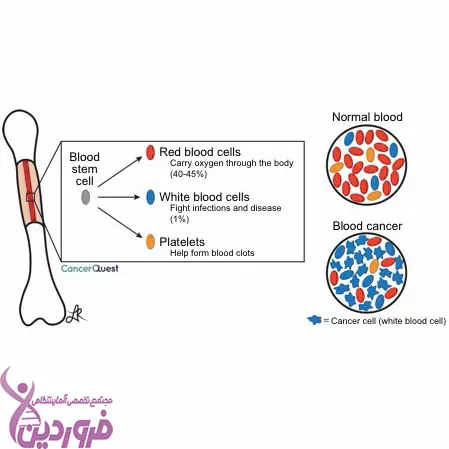 سرطان خون - آزمایشگاه فروردین - خون سالم و خون سرطانی