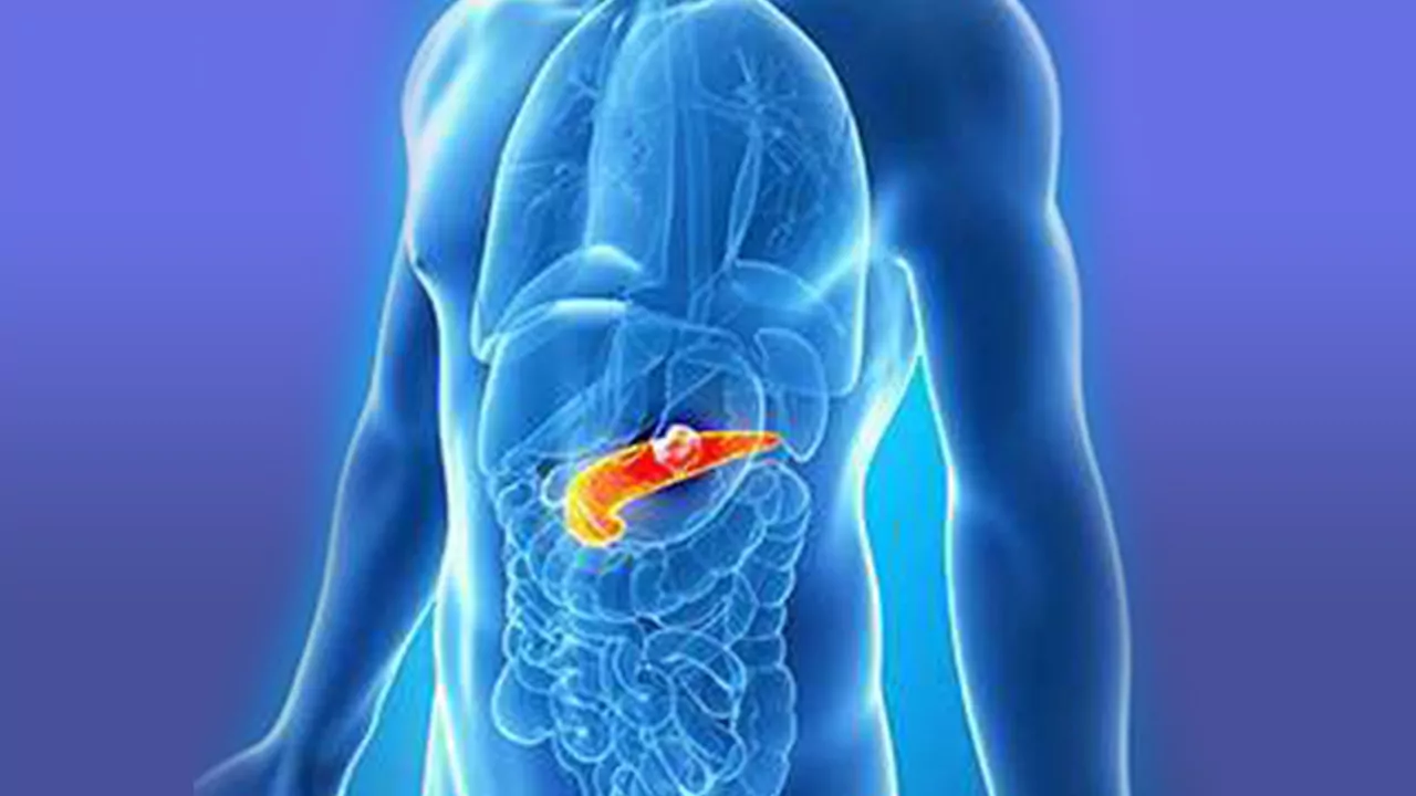 سرطان پانکراس