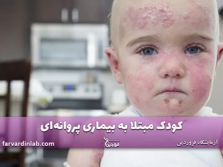 بیمار پروانه ای