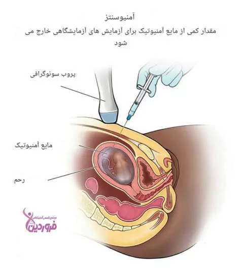 تشخیص سندروم داون در بارداری