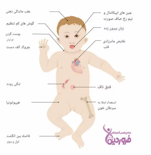 تشخیص سندروم داون در بارداری