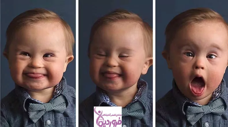 تشخیص سندروم داون در بارداری