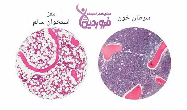 سرطان خون و مغز استخوان