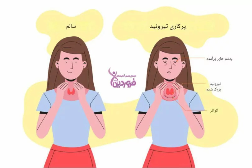 علائم کم کاری تیروئید - آزمایشگاه فروردین