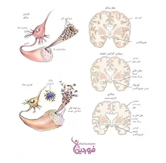 روشهای نوین ژنتیکی و شیمیایی برای تشخیص آلزایمر