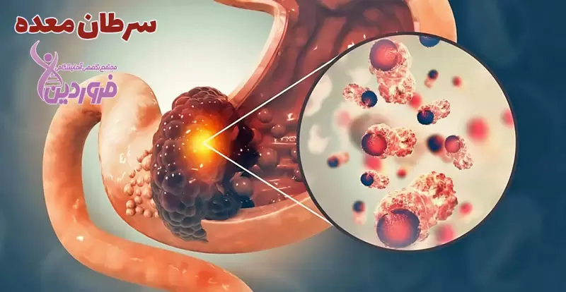 تصویر سرطان معده