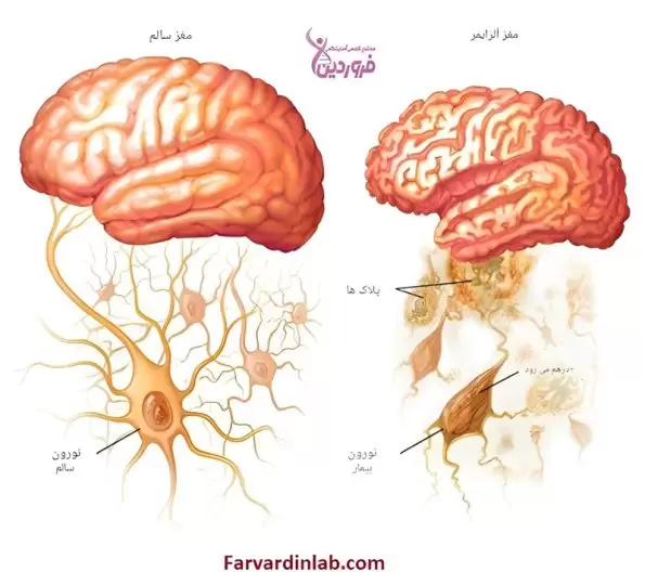 روشهای ژنتیکی برای تشخیص آلزایمر