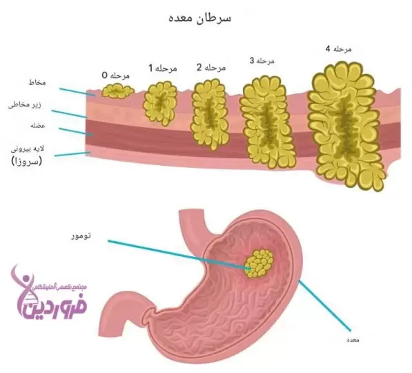 مراحل ایجاد تومور