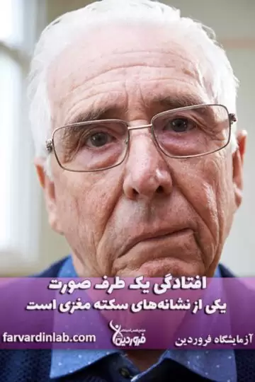 افتادگی صورت نشانه سکته مغزی