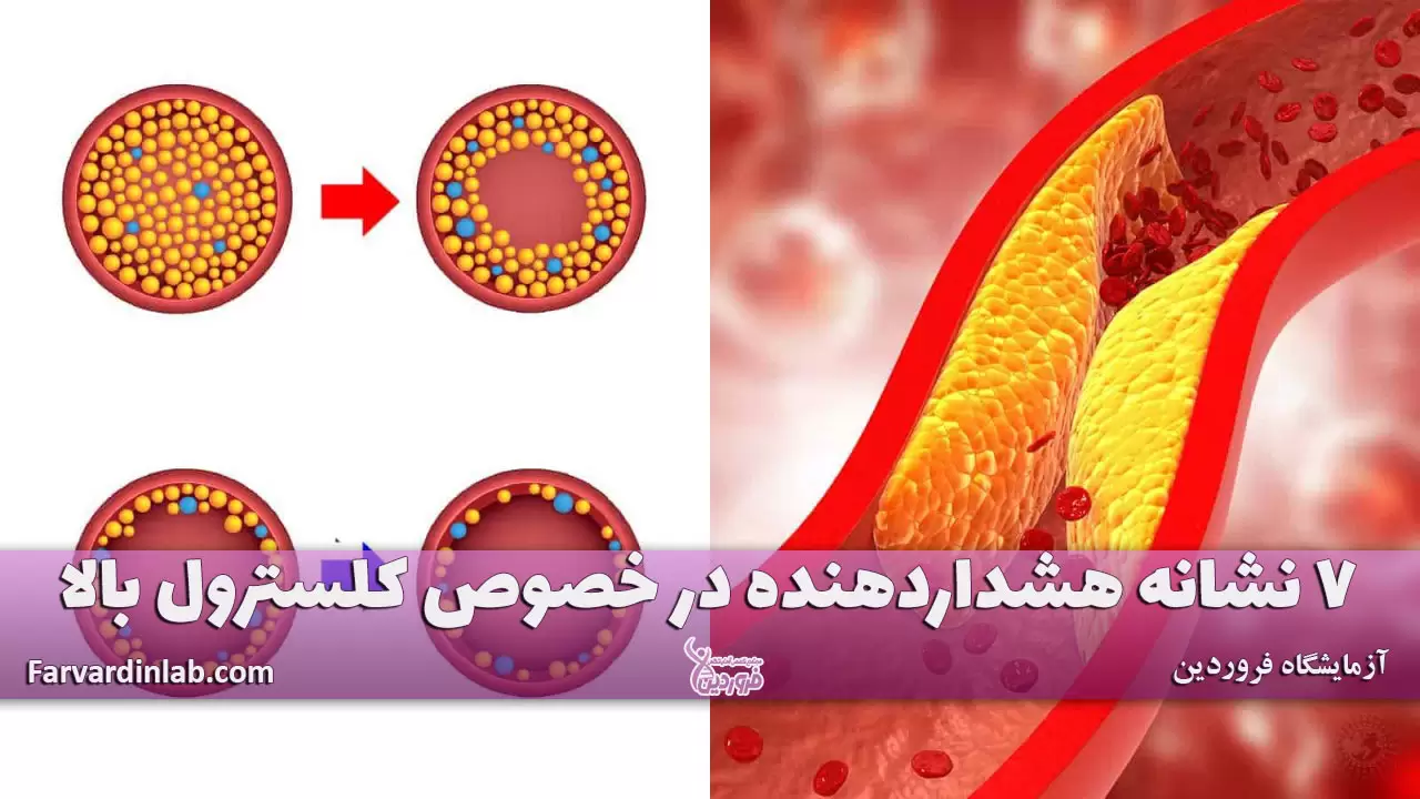 علائم کلسترول بالا