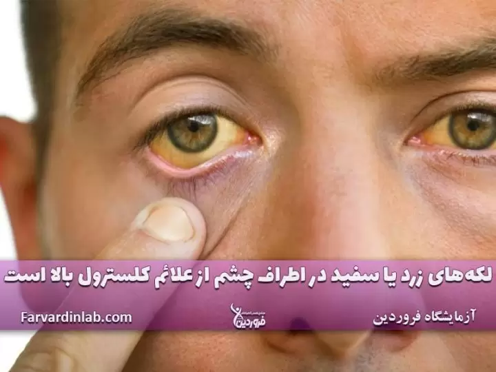 زردی چشم و کلسترول