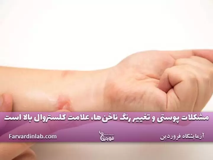 نشانه کلسترول در دستها