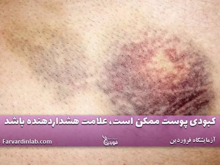 عکس سرطان خون