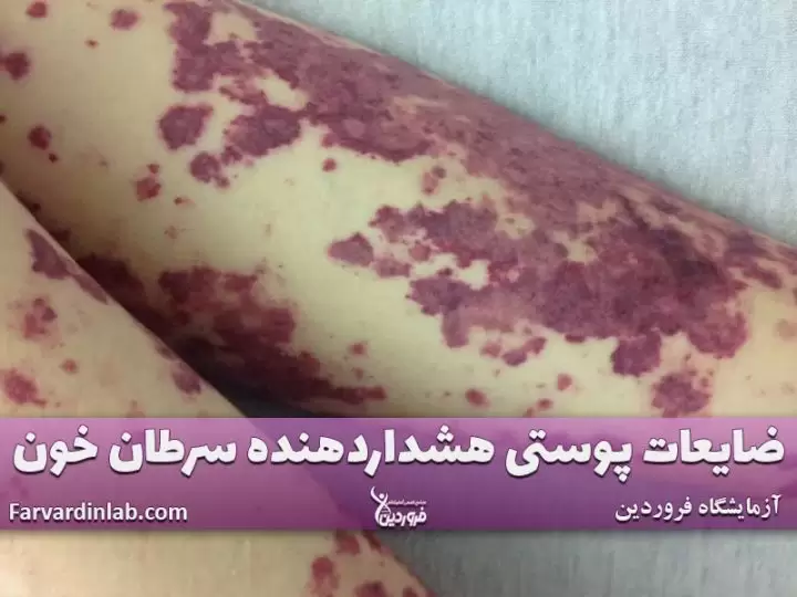 نشانه پوست سرطانی