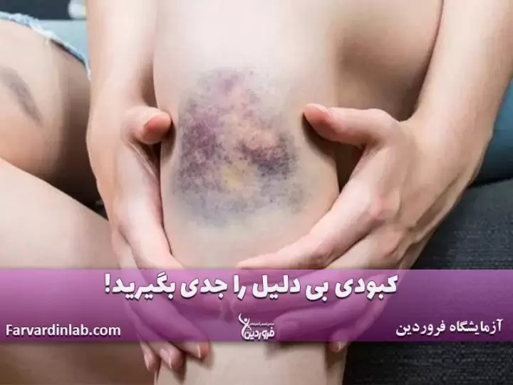 کبودی پا و سرطان خون
