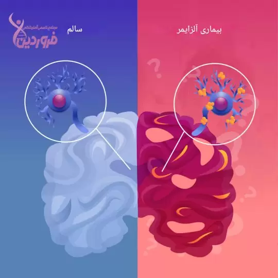تفاوت مغز سالم و مغز آلزایمری