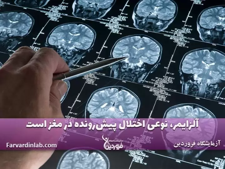 بیماری آلزایمر