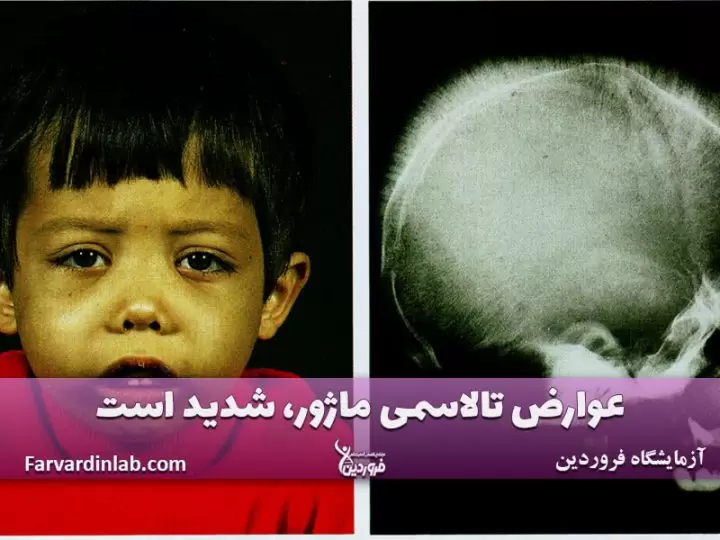 تالاسمی ماژور چیست؟